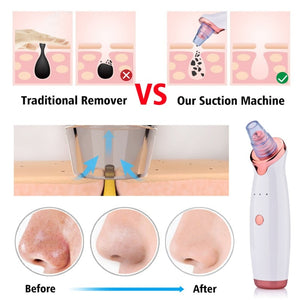 BLACK HEAD REMOVER